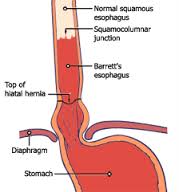 Barretts esophagus diagram