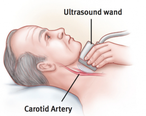Carotid Artery Disease 2