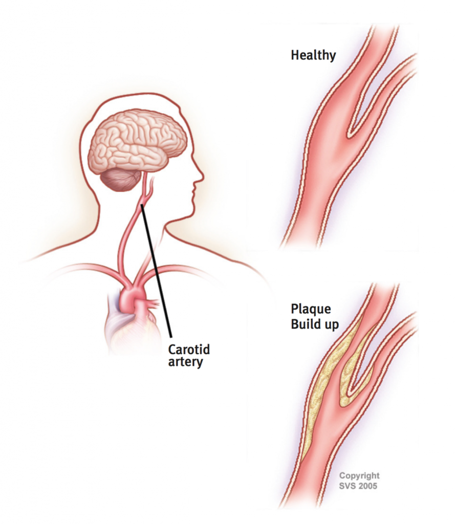 Carotid Artery Disease